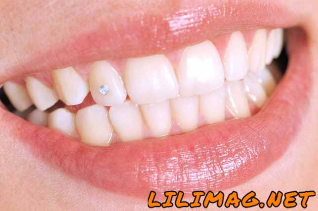 پیرسینگ دندان