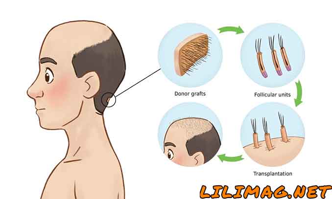 مراحل کاشت مو FUT