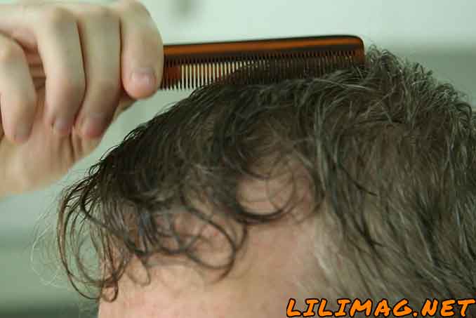مراقبت های بعد از کاشت مو به روش FUT