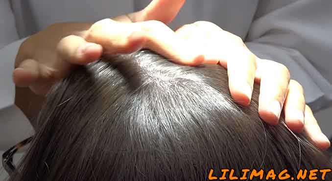معایب کاشت مو به روش HRT