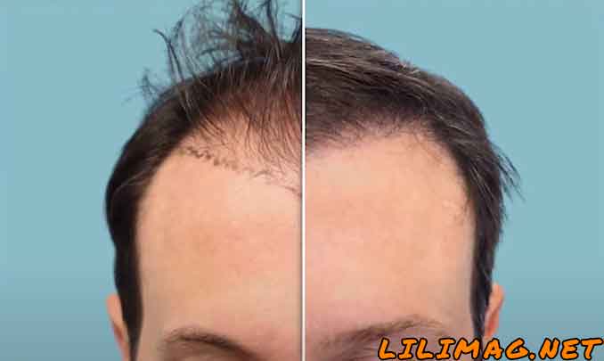 روند کاشت مو: مراحل رشد مو بعد از کاشت