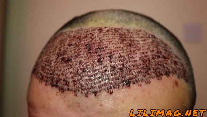 کیست‌های زیر پوستی، از اصلی‌ترین عوارض کاشت مو FIT