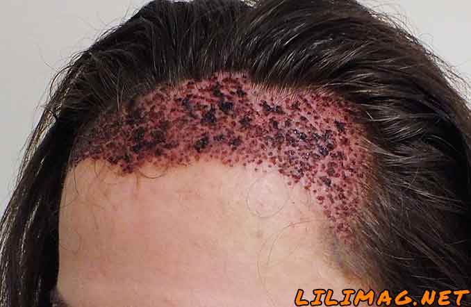 عوارض کاشت مو در ناحیه پیوند مو