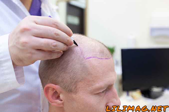 مراحل کاشت مو چگونه انجام می‌شود؟