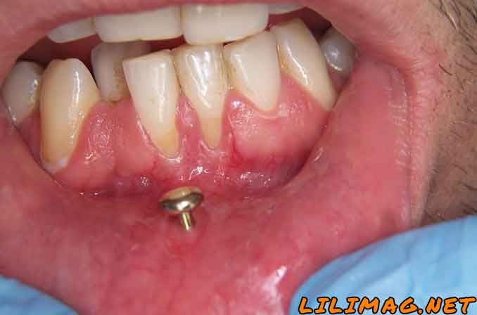 آسیب به لثه و دندان از عوارض پیرسینگ لب